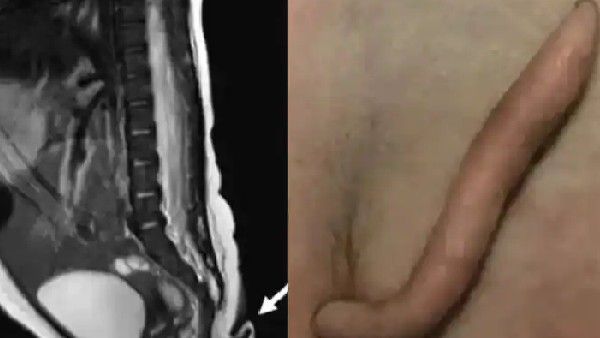 2 ಇಂಚು 'ಬಾಲ'ದೊಂದಿಗೆ ಜನಿಸಿದ ಮಗು: ಫೋಟೋ ವೈರಲ್