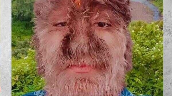 ಈ ಹುಡುಗನ ಮುಖದ ತುಂಬಾ ಕೂದಲು: ಈ ಕಾಯಿಲೆ ಏನು?