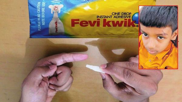 ಅಯ್ಯೋ ದುರ್ವಿದಿಯೇ...! ಗಾಯಕ್ಕೆ ಹೊಲಿಗೆ ಹಾಕುವ ಬದಲು ಫೆವಿಕ್ವಿಕ್ ಹಚ್ಚಿದ ವೈದ್ಯ!