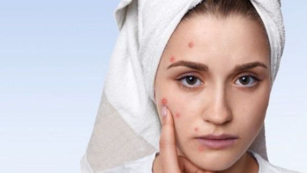 ಟೆನ್ಷನ್‌ ಬಿಡಿ: ಮೊಡವೆ ನಿವಾರಣೆಗೆ ಇಲ್ಲಿದೆ ಸುಲಭದ 5 ಮನೆ ಮದ್ದು!