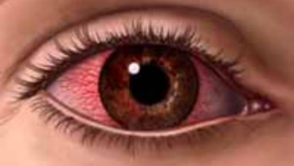 ದಾವಣಗೆರೆಯಲ್ಲಿ ಹೆಚ್ಚಿದ ಮದ್ರಾಸ್ ಐ: ವಿದ್ಯಾರ್ಥಿಗಳಲ್ಲಿ ವೇಗವಾಗಿ ಹರಡುತ್ತಿದೆ ವೈರಾಣು