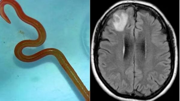 ವಿಶ್ವದ ಮೊದಲ ಕೇಸ್: ಆಸ್ಟ್ರೇಲಿಯಾ ರೋಗಿಯ ಮೆದುಳಿನಲ್ಲಿ ಜೀವಂತ ಹುಳ ಪತ್ತೆ: ಸ್ಕ್ಯಾನ್ ಕಂಡು ವೈದ್ಯರು ಶಾಕ್!