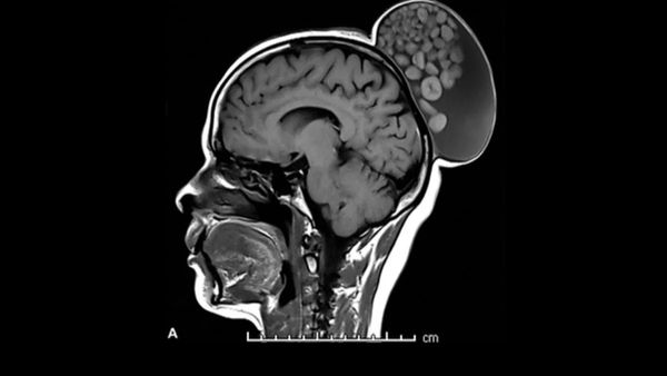 ಚಿಕ್ಕಂದಿನಿಂದಲೂ ಮಹಿಳೆಯ ನೆತ್ತಿಯ ಮೇಲೆ ಬೆಳೆದಿದ್ದ 'ಮಾರ್ಬಲ್ಸ್' ತೆಗೆದ ಬೆಂಗಳೂರಿನ ವೈದ್ಯರು