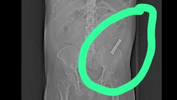 ಕುಡಿದ ಮತ್ತಿನಲ್ಲಿ 8 ವರ್ಷದ ಹಿಂದೆ ನೈಲ್ ಕಟ್ಟರ್ ನುಂಗಿದ್ದ ವ್ಯಕ್ತಿ: ಮುಂದಾ..