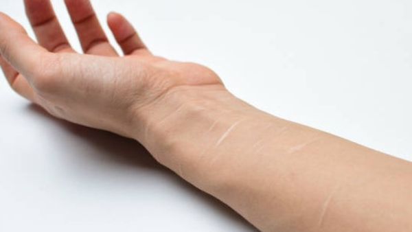 ದಾಂಡೇಲಿ: 14 ವಿದ್ಯಾರ್ಥಿನಿಯರ ಕೈಗಳ ಮೇಲೆ ಬ್ಲೇಡಿನಿಂದ ಹೆಚ್ಚಿದ ಗುರುತುಗಳು ಪತ್ತೆ