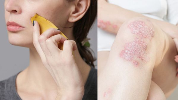 Skin Care: ಸೋರಿಯಾಸಿಸ್‌ನಂತಹ ಚರ್ಮದ ಸಮಸ್ಯೆ ಇದೆಯೇ? ಈ ಹಣ್ಣು ಹಚ್ಚುವುದು ತುಂಬಾ ಒಳ್ಳೆಯದು...