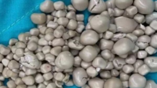 ಐವತ್ತಲ್ಲ..ನೂರಲ್ಲ..ಈ ಮಹಿಳೆಯ ಕಿಡ್ನಿಯಲ್ಲಿತ್ತು ಬರೋಬ್ಬರಿ 300ಕ್ಕೂ ಅಧಿಕ ಕಲ್ಲುಗಳು..!