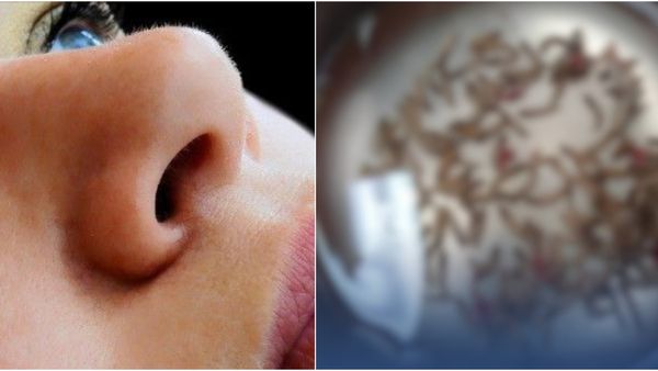 ಒಂದಲ್ಲಾ..ಎರಡಲ್ಲಾ..ಮಹಿಳೆಯ ಮೂಗಿನೊಳಗೆ 100ಕ್ಕೂ ಹೆಚ್ಚು ಜೀವಂತ ಹುಳುಗಳು