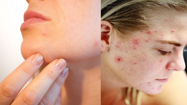 ಮೊಡವೆಗಳ ಮೇಲೆ ಕೈಯ್ಯಾಡಿಸುವುದನ್ನು ಬಿಟ್ಟು ಬಿಡಿ: ಯಾಕೆ ಗೊತ್ತಾ..?