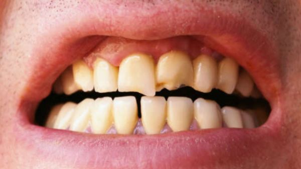 ಬೆಂಗಳೂರಿಲ್ಲಿ ವಿದ್ಯಾರ್ಥಿಗೆ ಹಲ್ಲುದುರಿಸಿದ ಶಿಕ್ಷಕಿ-ಎಫ್‌ಐಆರ್‌ ದಾಖಲು