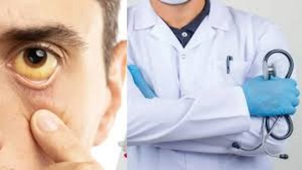 Jaundice: ಕಾಮಾಲೆ ರೋಗದತ್ತ ಎಚ್ಚರಿಕೆ ವಹಿಸಿ: ಯಾಕೆ ಗೊತ್ತಾ?