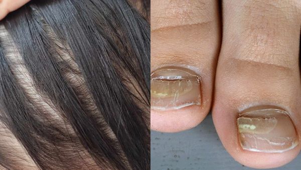 ಮಹಾರಾಷ್ಟ್ರದಲ್ಲಿ ವಿಚಿತ್ರ ಕಾಯಿಲೆ: ಉದುರುತ್ತಿವೆ ಜನರ ಕೂದಲು, ಉಗುರುಗಳು