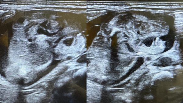 ಮಗುವಿನೊಳಗೊಂದು ಮಗು ಕರ್ನಾಟಕದಲ್ಲಿ ಅಪರೂಪದ ಪ್ರಕರಣ!