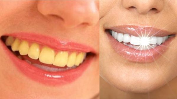 Teeth Tips: ಪ್ರತಿದಿನ ಹಲ್ಲುಜ್ಜಿದರೂ ಹಲ್ಲುಗಳು ಹಳದಿಯೇ? ನಗು ಮಾಸದಿರಲು ದಂತ ವೈದ್ಯರ ಸಲಹೆ ಪಾಲಿಸಿ