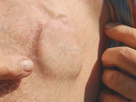 കൃത്രിമ ഹൃദയം ഇന്ത്യയില്‍, വില ഒരു കോടി