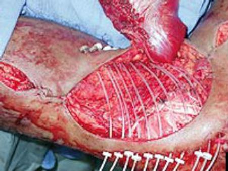 ശസ്ത്രക്രിയയിലൂടെ നീക്കിയത് 10 കിലോയുള്ള മുഴ