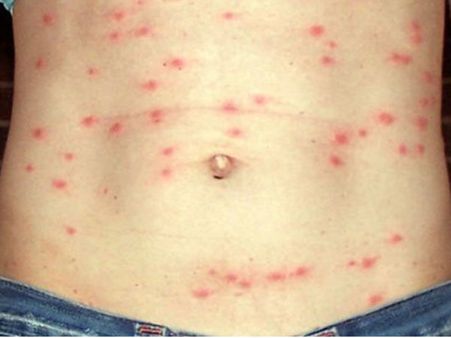 മരണപ്പനി ഗ്രാമങ്ങളില്‍ നിന്ന് നഗരങ്ങളിലേക്ക്