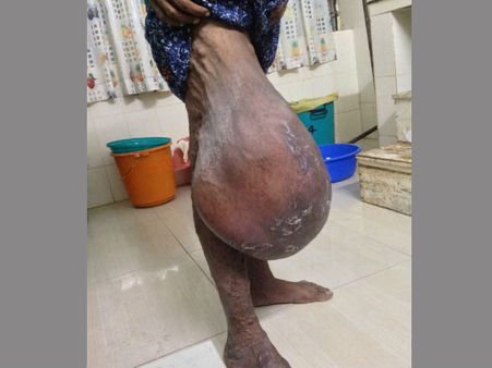 കാലില്‍ മുഴ: തൂക്കം 15 കിലോ