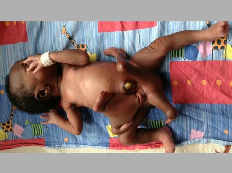 എട്ടുകാലിയെ പോലെ ഒരു മനുഷ്യക്കുട്ടി