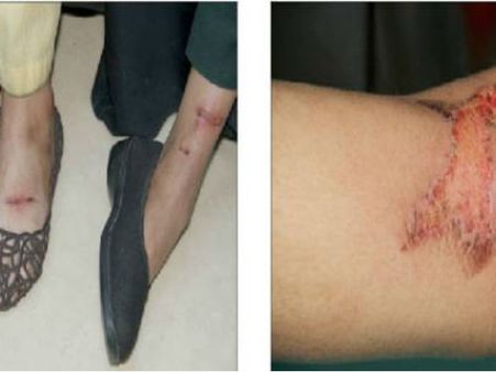 100 റിയാലിന് വേണ്ടി പിതാവ് 3മാസം പ്രായമുള്ള കുഞ്ഞിനെ പൊള്ളിച്ചു