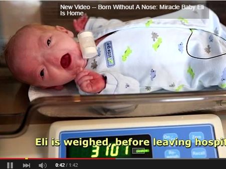 യുഎസില്‍ നവജാത ശിശുവിന് മൂക്കില്ല