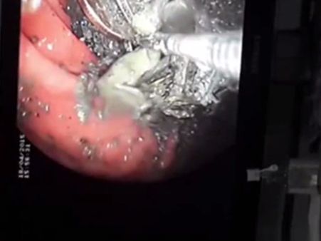 34കാരന്റെ വയറ്റില്‍ നീക്കം ചെയ്തത് 140 നാണയങ്ങളും 150 ആണികളും