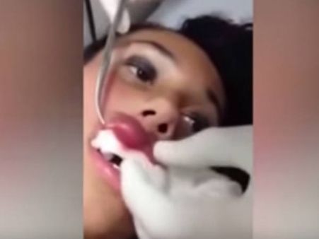 യുവതിയുടെ ചുണ്ടില്‍ നിന്നും പുഴുവിനെ പുറത്തെടുക്കുന്ന വീഡിയോ വൈറലാവുന്നു