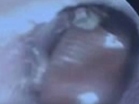 ചെവിവേദന, യുവാവിന്റെ ചെവിയില്‍ നിന്ന് കിട്ടിയത് പാറ്റയെയും 25 കുഞ്ഞുങ്ങളെയും