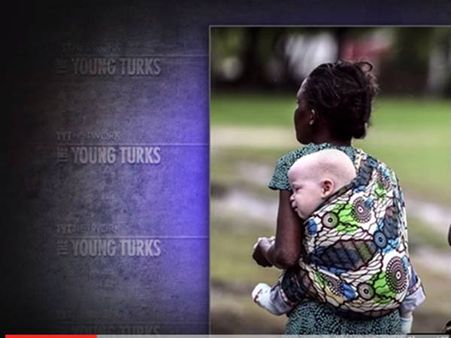 ആഫ്രിക്കയില്‍ മനുഷ്യനാല്‍ 'വേട്ടയാടി' കൊല്ലപ്പെടുന്ന ആല്‍ബിനോ മനുഷ്യര്‍,കണ്ണ് നനയിക്കുന്ന സത്യം,കാണൂ