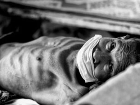 ശ്രദ്ധിക്കണേ ക്ഷയരോഗം പിന്നാലെയുണ്ട്