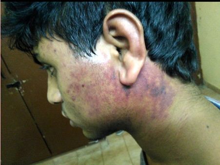 ബെംഗളുരു എഞ്ചിനിയറിംഗ് കോളേജില്‍ വടകര സ്വദേശിക്ക് ക്രൂരമായ റാഗിങ്ങ്