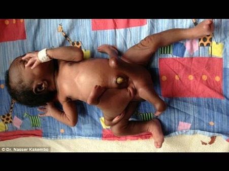 മൂന്ന് കാലുള്ള പെണ്‍കുട്ടിയോ!! ശസ്ത്രക്രിയയിലൂടെ വിജയകരമായി നീക്കം ചെയ്തു എന്ന് റിപ്പോര്‍ട്ട്