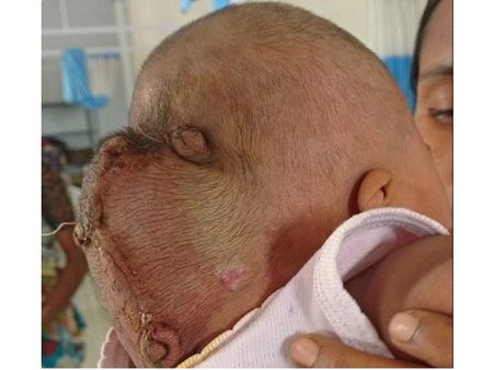 5 മാസം പ്രായമായ കുഞ്ഞിന്റെ 'ഇരട്ടതല' നീക്കം ചെയ്തു