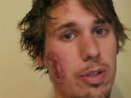 മുഖം അഴുകി വികൃതമാകുന്ന 'അലെപ്പോ ഈവിള്‍' രോഗം മിഡില്‍ ഈസ്റ്റ് രാജ്യങ്ങളില്‍, അടുത്തത് സൗദിയില്‍?