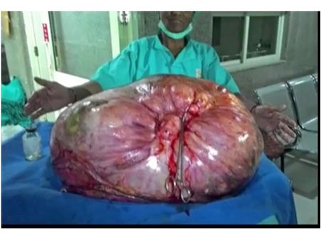 യുവതിയുടെ വയറില്‍ നിന്നും നീക്കം ചെയ്തത് 100 കിലോ ഭാരമുള്ള ടൂമര്‍, വീഡിയോ കാണൂ..