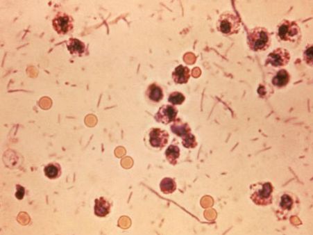 കുടല്‍ തിന്ന് കൊല്ലുന്ന ബാക്ടീരിയ കേരളത്തിലും... അതീവ ജാഗ്രത