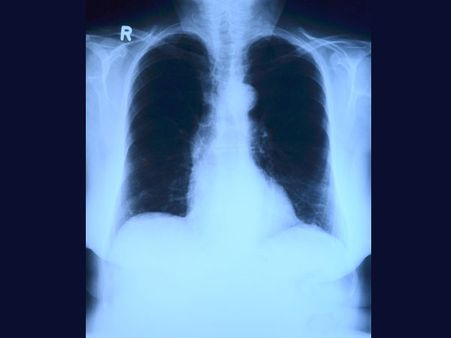 എക്‌സ് റേ ടെസ്റ്റ് പാസായാല്‍ മാത്രം വേശ്യാവൃത്തി, പെണ്‍കുട്ടികളെ രക്ഷിക്കാന്‍ പുതിയ മാര്‍ഗം