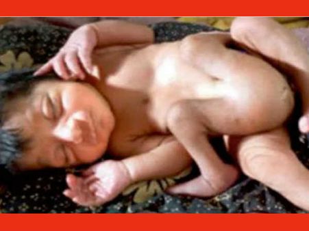 കുഞ്ഞിന് രണ്ട് ലിംഗങ്ങളും നാല് കാലുകളും..!! ദൈവത്തിന്റെ അവതാരമെന്ന് അമ്മ.. !!