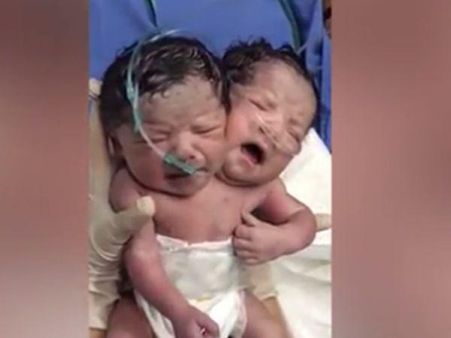 ഒരു ഉടല്‍, രണ്ട് തല, വല്ലാത്തൊരു ജന്മം ഈ കുട്ടിയുടേത്, ഞെട്ടലോടെ ഡോക്ടര്‍മാര്‍