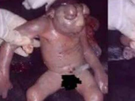 എട്ടാം മാസം യുവതി പ്രസവിച്ചത് തവളക്കുഞ്ഞിനെ...!! ഭയം വിട്ടുമാറാതെ ഒരു ഗ്രാമം... !