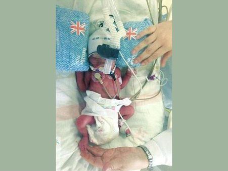 ഒരാഴ്ചക്കിടെ യുവതി പ്രസവിച്ചത് രണ്ടുതവണ; മൂന്ന് കുട്ടികള്‍, അപൂര്‍വ സംഭവം, അന്ധാളിച്ച് ഡോക്ടര്‍മാര്‍