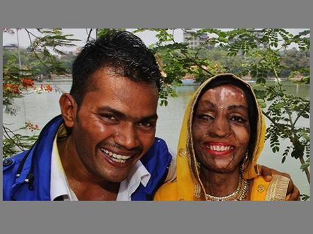 ആസിഡ് ആക്രമണം,17 സര്‍ജറികള്‍,മുംബൈ പെണ്‍കുട്ടിക്ക് പുതുജീവിതം നല്‍കിയത് റോങ്‌നമ്പര്‍!!