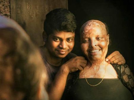 കാണുന്നത് ആശുപത്രിയിൽ വെച്ച്, പച്ചമാംസം ഉരുകുന്ന വേദന അയാളുടെ സന്ദർശനമില്ലാതാക്കി, പ്രണയകഥ ഇങ്ങനെ