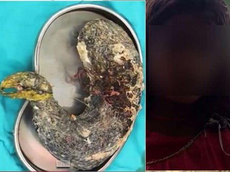 15കാരിക്ക് ട്രിക്കോബെസോര്‍! അകത്താക്കിയത് രണ്ടു കിലോ തലമുടി! സംഭവം തിരുവനന്തപുരത്ത്...