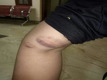 വിദ്യാര്‍ത്ഥിക്ക് നേരെ അധ്യാപകന്റെ ക്രൂര മര്‍ദ്ദനം; വിദ്യാര്‍ത്ഥി ആശുപത്രിയില്‍