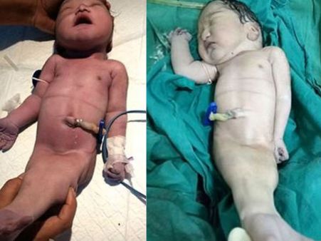 കുഞ്ഞ് പിറന്നത് മത്സ്യകന്യകയുടെ രൂപത്തിൽ.. അരയ്ക്ക് താഴെ വാൽ.. ചിത്രം സോഷ്യൽ മീഡിയയിൽ വൈറൽ