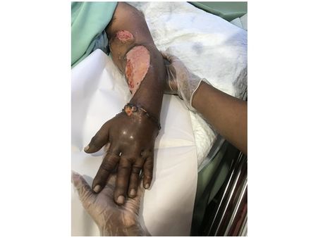 കൊപ്ര മെഷീനില്‍പെട്ട് അറ്റുപോയ കണ്ണൂർ സ്വദേശിനിയുടെ കൈപ്പത്തി വിജയകരമായി തുന്നിച്ചേര്‍ത്തു