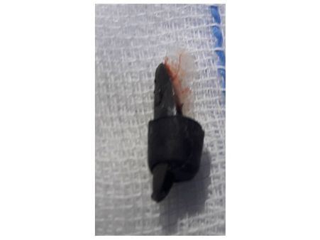 ശ്വാസകോശത്തില്‍ വിസില്‍ കുരുങ്ങിയത് മൂന്നു മാസം, ഒടുവില്‍ ശസ്ത്രക്രിയ കൂടാതെ പുറത്തെടുത്തു..