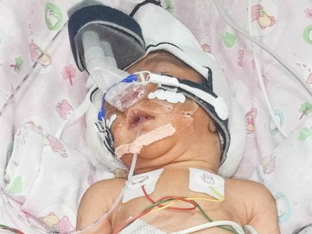 മാസം തികയാതെ ജനിച്ച പെൺകുഞ്ഞ് NICU-വിലെ ചികിത്സ കാത്ത് കഴിയുന്നു