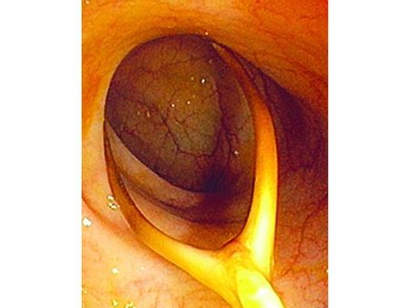 ഭക്ഷണം കഴിക്കുന്നതിനിടെ 72വയസ്സുകാരന്റെ വന്‍കുടലില്‍ കുടുങ്ങിയ കോഴിയെല്ല്: പിന്നീട് പുറത്തെടുത്തു